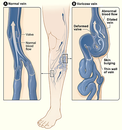 varicose veins